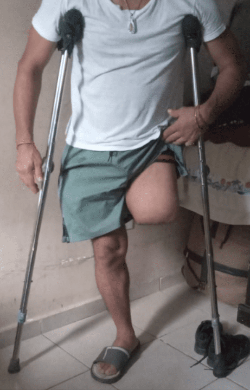 Álvaro Ignacio Varela Feria - candidato a prótesis